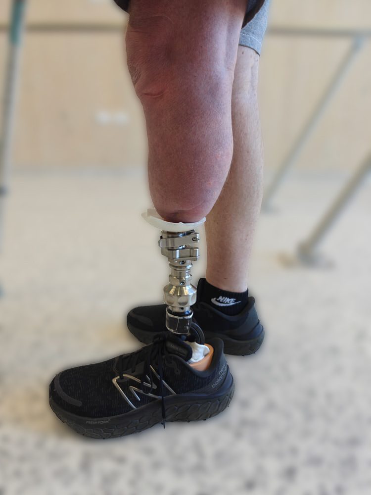 Transtibial osseointegration