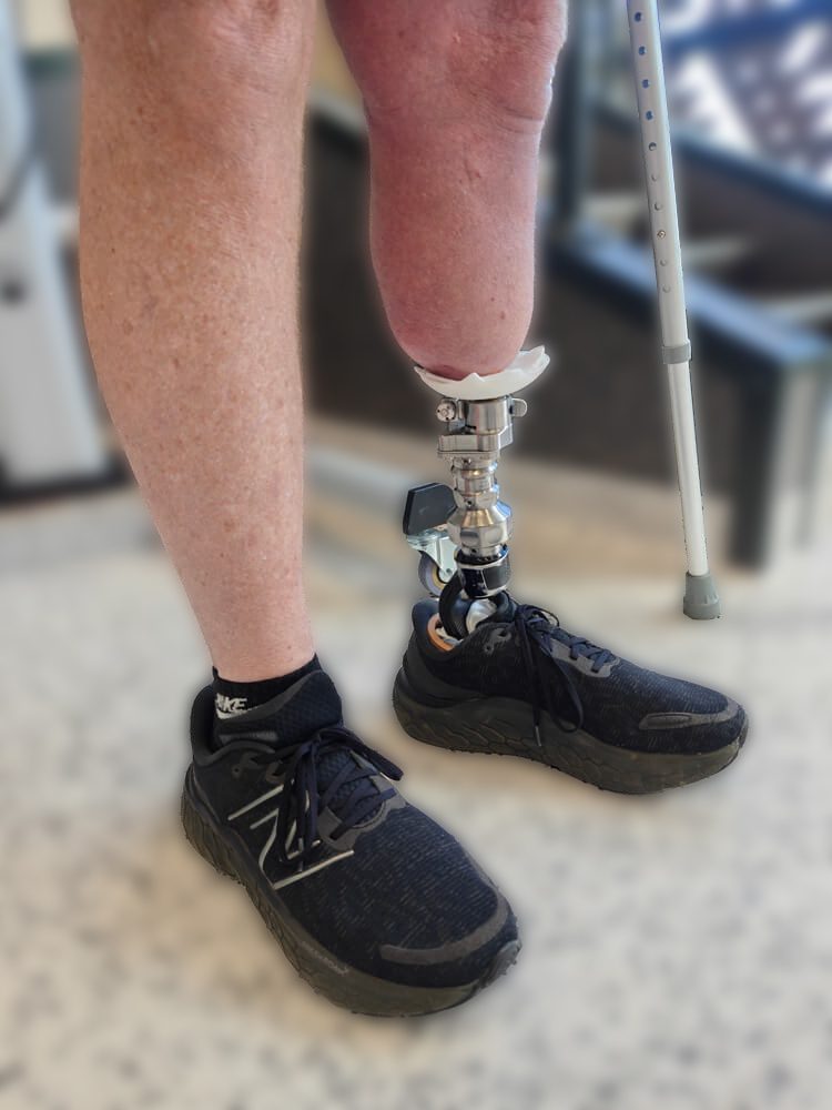 Transtibial osseointegration
